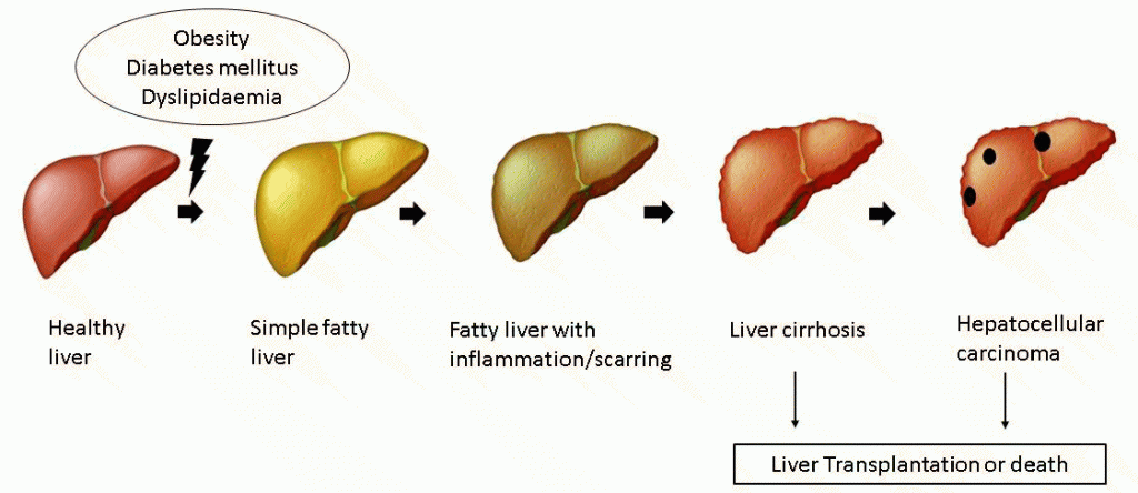 Non Alcoholic Fatty Liver Diseases