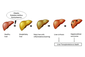 From Fatty Food To A Sedentary Lifestyle, All Can Contribute To Liver 