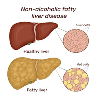 Nonalcoholic Steatohepatitis occurs due to liver cell damage. know ...