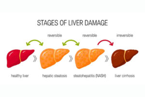 Nonalcoholic Steatohepatitis occurs due to liver cell damage. know ...